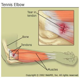 can an x ray show tennis elbow